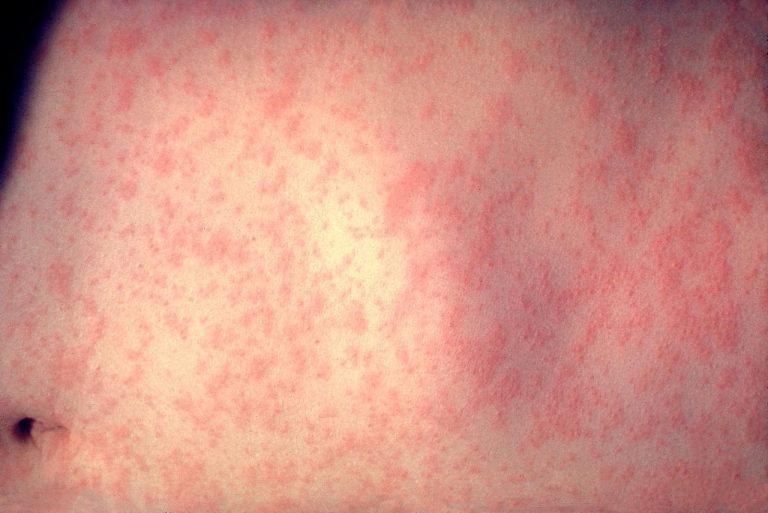 1280px Morbillivirus measles infection