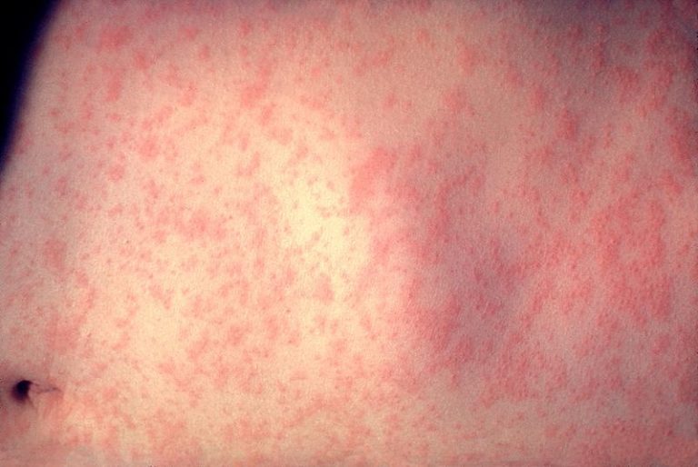 800px Morbillivirus measles infection