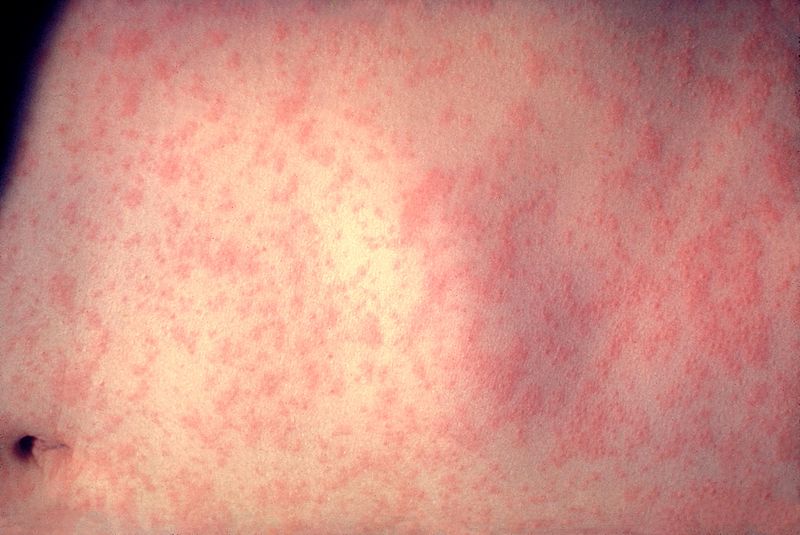 measles outbreak