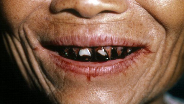 81757440 m3720067 close up of betel stained teeth of thai woman spl