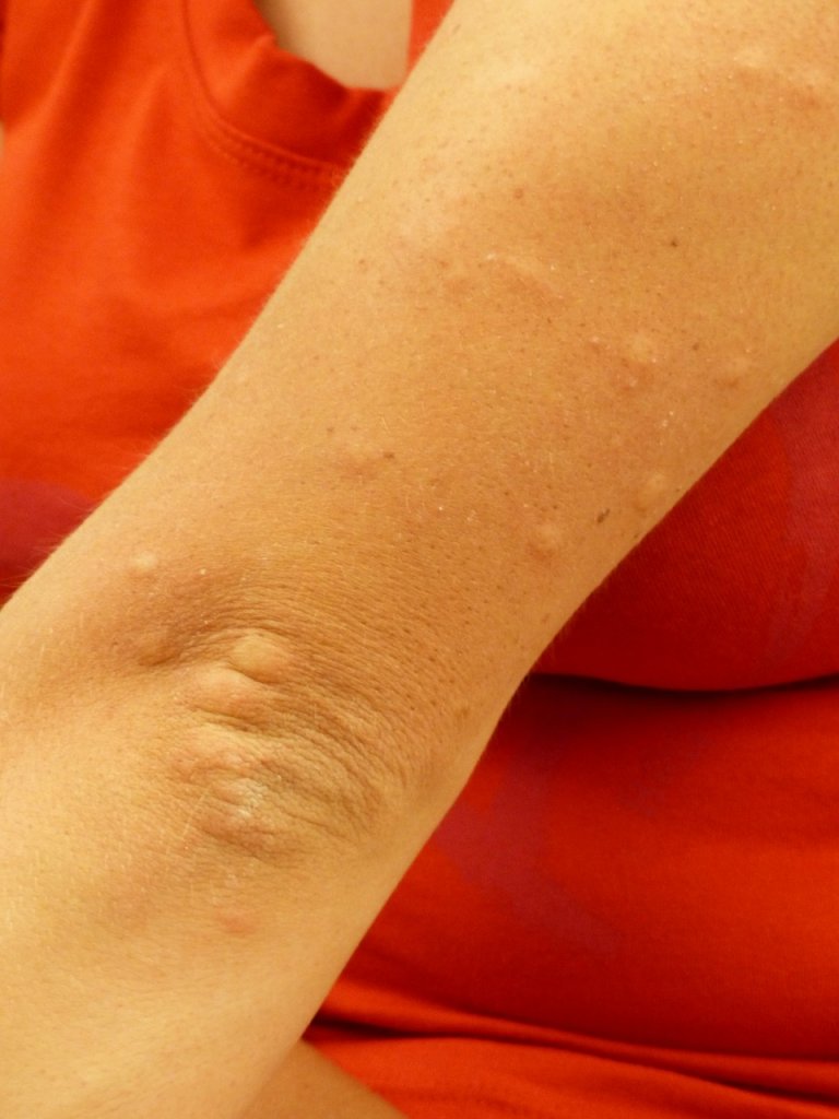 COVID-19 vaccine allergic reaction