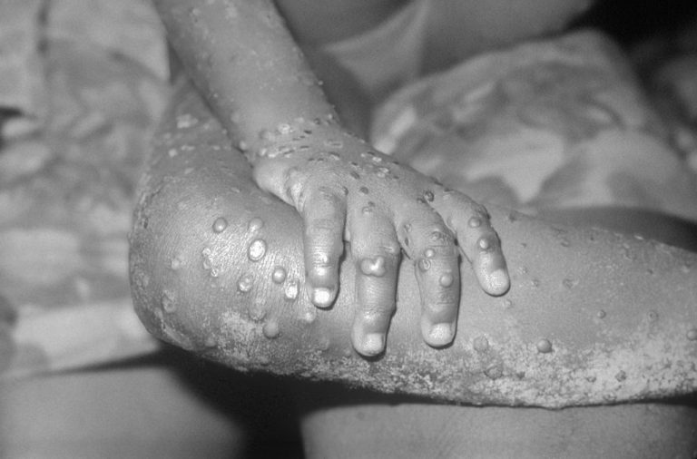 Expert warns monkeypox virus may enter Philippines via travelExpert warns monkeypox virus may enter Philippines via travel