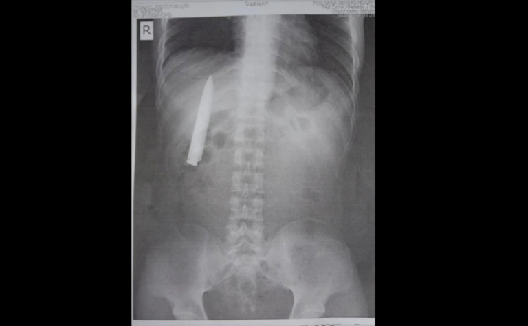 Man with knife stuck in his chest to get free operation