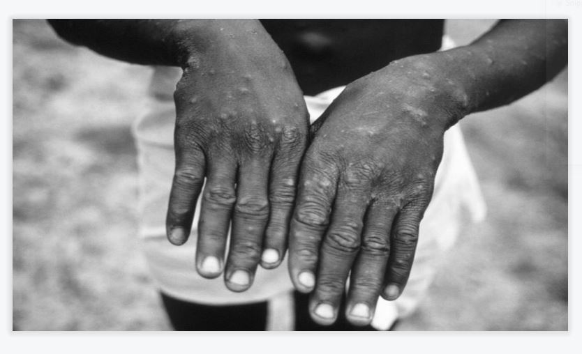 Philippines intensifies border control to prevent monkeypox entry PLN