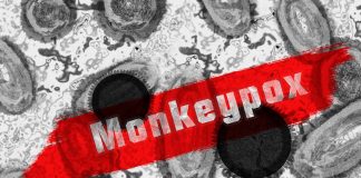 Monkeypox virus enters the Philippines
